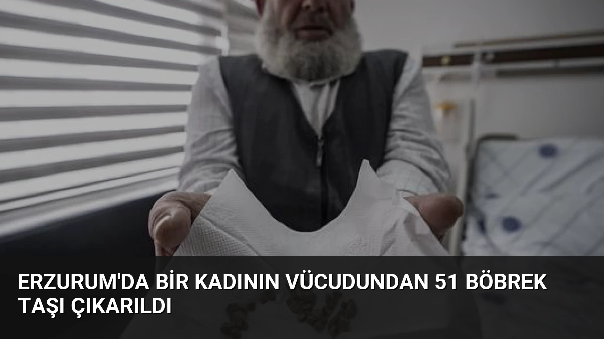 Erzurum’da Bir Kadının Vücudundan 51 Böbrek Taşı Çıkarıldı