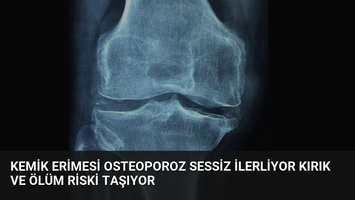 Kemik Erimesi Osteoporoz Sessiz İlerliyor Kırık ve Ölüm Riski Taşıyor