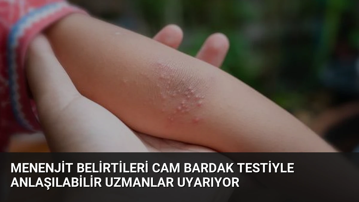 Menenjit Belirtileri Cam Bardak Testiyle Anlaşılabilir Uzmanlar Uyarıyor