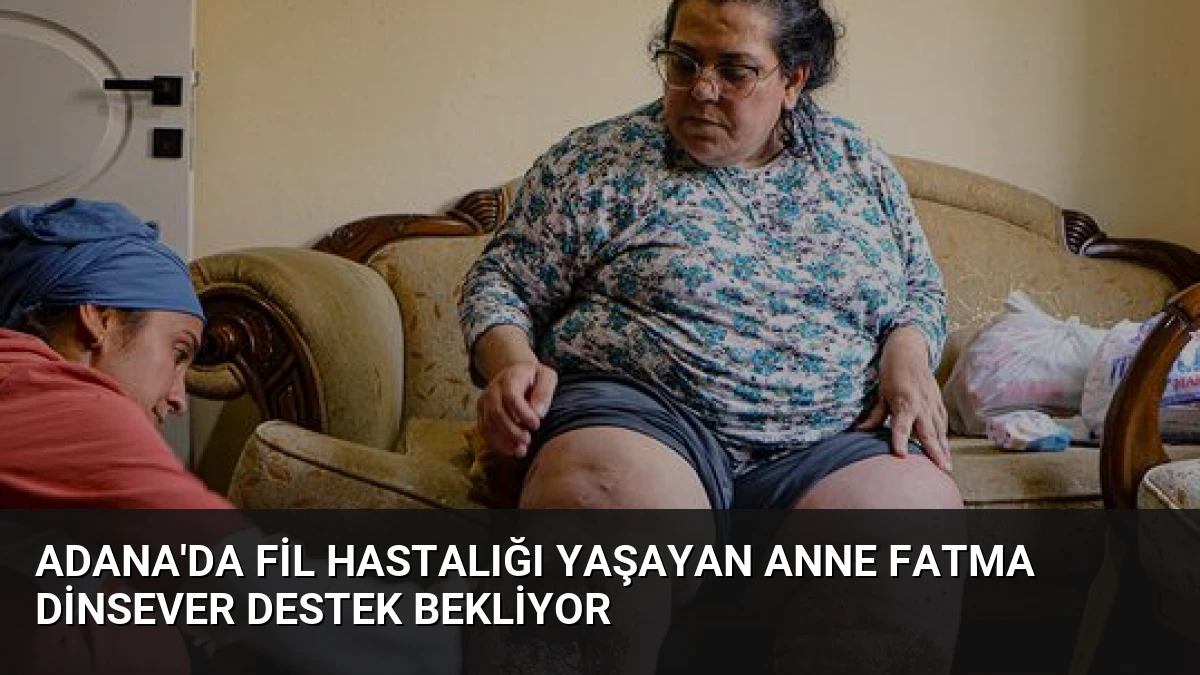 Adana’da Fil Hastalığı Yaşayan Anne Fatma Dinsever Destek Bekliyor