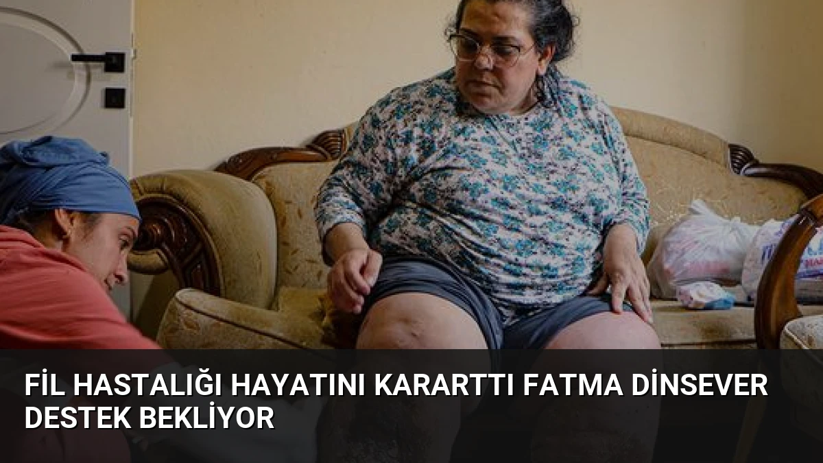 Fil Hastalığı Hayatını Kararttı Fatma Dinsever Destek Bekliyor